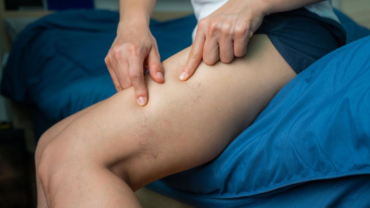 Lekarz obala mity na temat żylaków. Wielu Polaków wciąż w nie wierzy