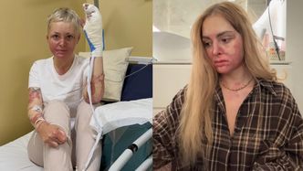 Przez eksplozję biokominka PALIŁA SIĘ ŻYWCEM! Poparzona tiktokerka ODRZUCIŁA propozycję sądu