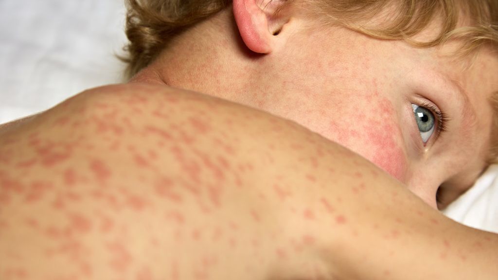 Różyczka objawia się przede wszystkim wysypką na całym ciele