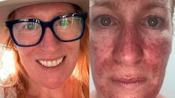 Tak wygląda rak skóry. Pokazała zdjęcia