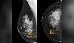 Google diagnozuje raka piersi lepiej niż lekarze. O 9,4 procent więcej właściwych wskazań