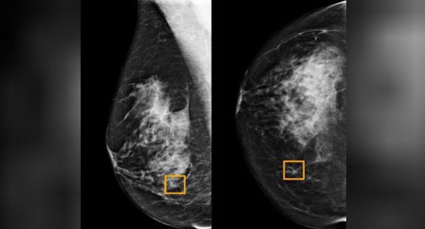 Google diagnozuje raka piersi lepiej niż lekarze. O 9,4 procent więcej właściwych wskazań