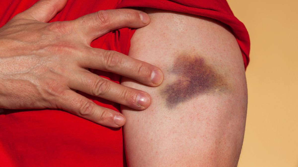 Zwiększona podatność na siniaki może być objawem chorej wątroby