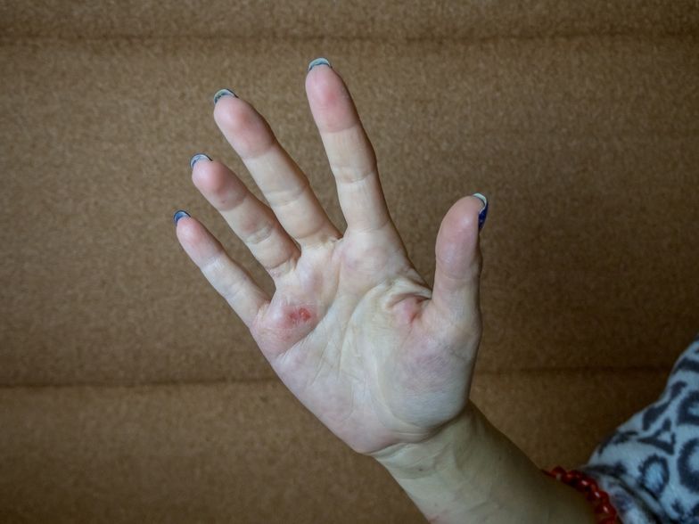 Gdy pojawią się na dłoniach, mogą sygnalizować raka żołądka