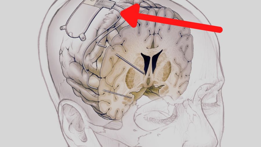 Znaleźli sposób na depresję? Nowa metoda zadziałała. Naukowcy mówią o przełomie 1