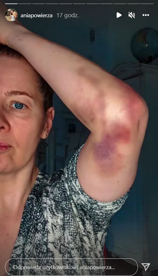 Anna Powierza pokazała koszmarne zdjęcia. Tak pobrano jej krew