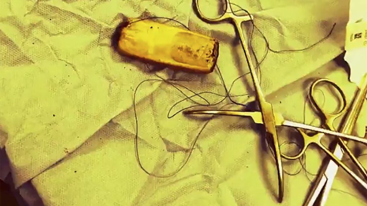 W brzuchu pacjenta wykryto tajemniczy obiekt. Okazało się, że to telefon komórkowy