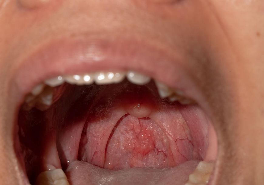 Alergie i niedobory mogą powodować puchnięcie języka