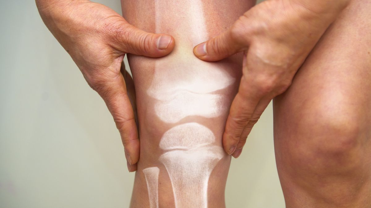 X-ray of knee - osteoarthritis and rheumatoid arthritisPhysical Therapy trying to relieve pain, injury shown in x-rayPeter Dazeley
