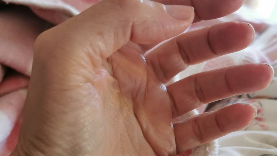 "Trupia ręka". Objaw pojawia się na dłoniach