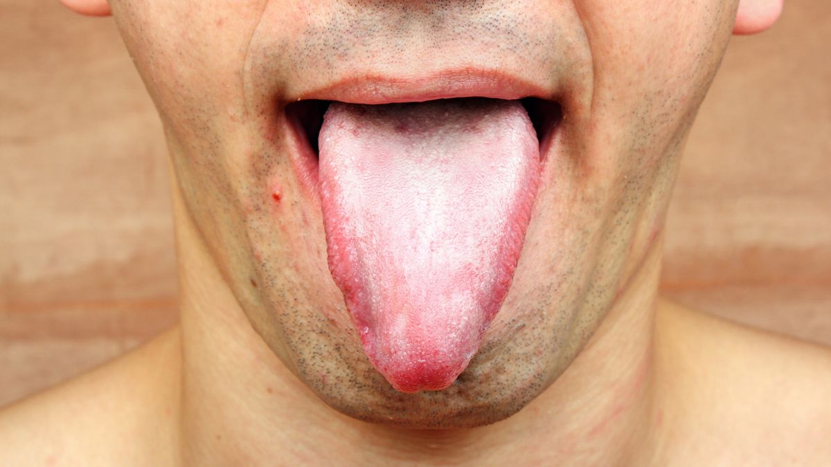 Infection tongueInfection tongue disease candida albicansAdam88xxTreponema Pallidum, Anemia, Inflammation, Heart Disease, Men, Epidemic, Throat, Cold And Flu, Yeast, Thrush, Problems, Imbalance, Sadness, Chaos, Red, Messy, Human Mouth, Illness, Fungus, Bacterium
