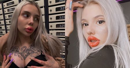 Influencerka chciała zmniejszyć usta. Po zabiegu urosły do MONSTRUALNYCH rozmiarów. "PRAWIE UMARŁAM"