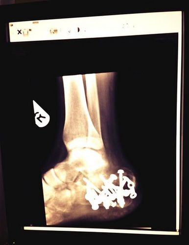 Zdjęcie rentgenowskie pięty Chrisa Holdera po operacji