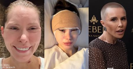 Te gwiazdy i influencerki zrobiły sobie lifting twarzy. NAJMŁODSZA ma dopiero 27 lat (ZDJĘCIA)