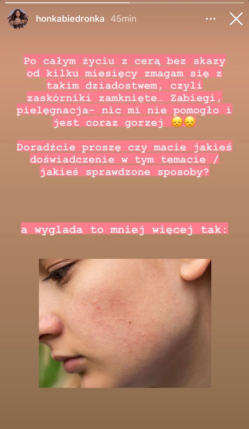 Honorata Skarbek ma poważny problem z cerą