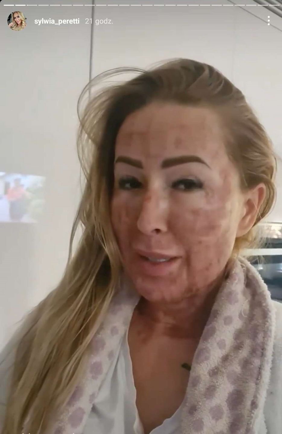 Sylwia Peretti pokazuje kolejny etap po zabiegu laserowym. Jest lepiej? 