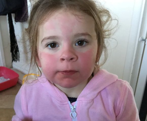 Dziewczynka ma ostrą reakcję alergiczną na niskie temperatury i musi przebywać w cieple