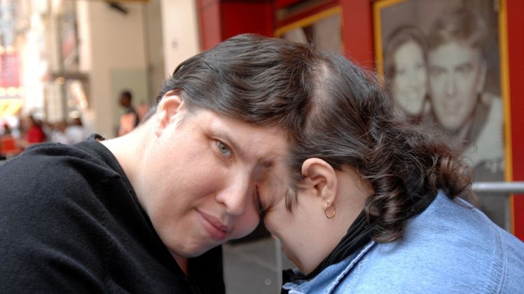 Najsłynniejsze bliźnięta syjamskie żyją razem od 61 lat