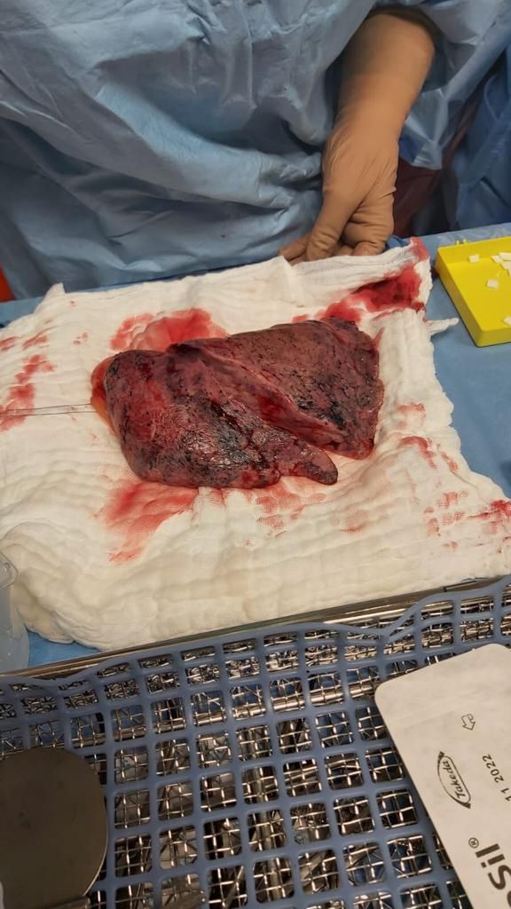 Zniszczone przez COVID-19 płuca pana Grzegorza. Fotografia wykonana tuż po wycięciu organu