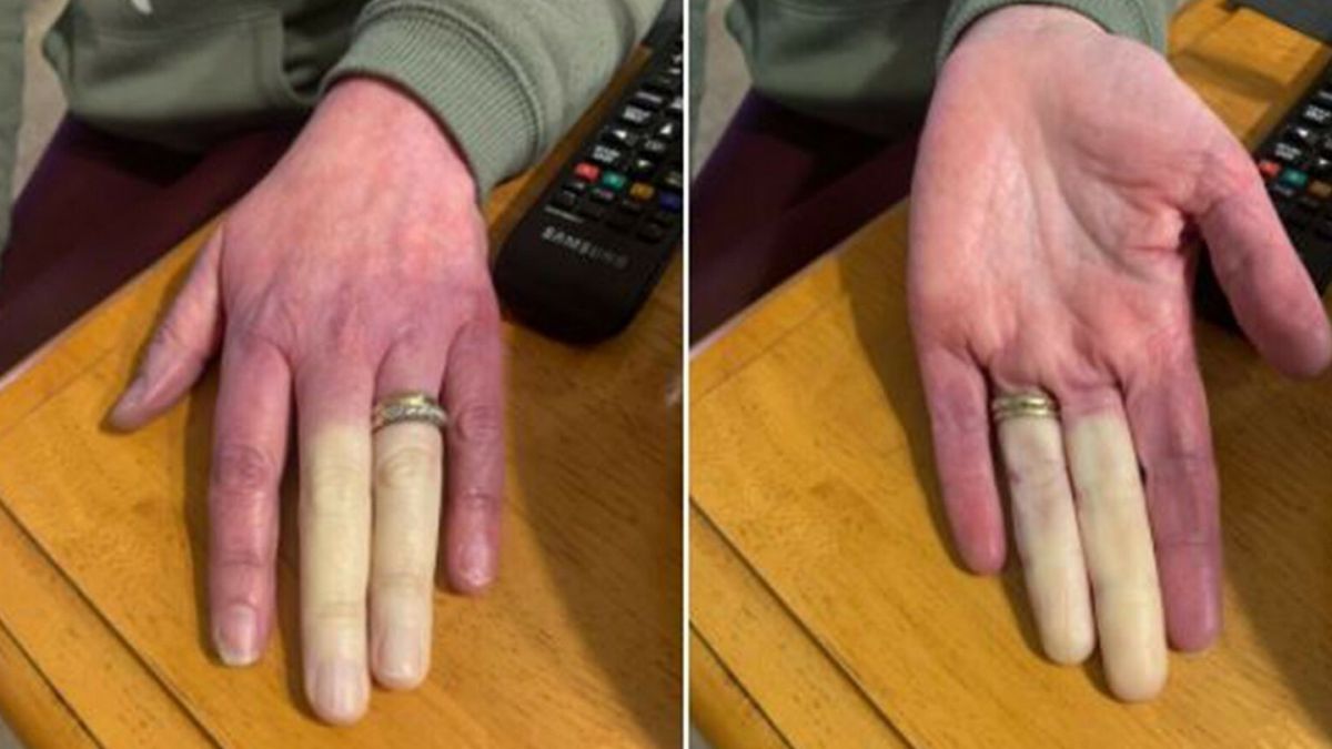 Eksperci szacują, że choroba Raynauda może dotykać ok. 5 proc. populacji. Główny objaw to zmiana koloru palców pod wpływem zimna