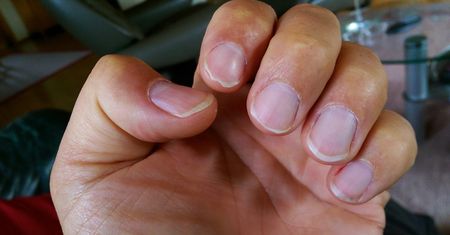 Alarmują, że tętnice są zapchane cholesterolem. Dwa subtelne znaki