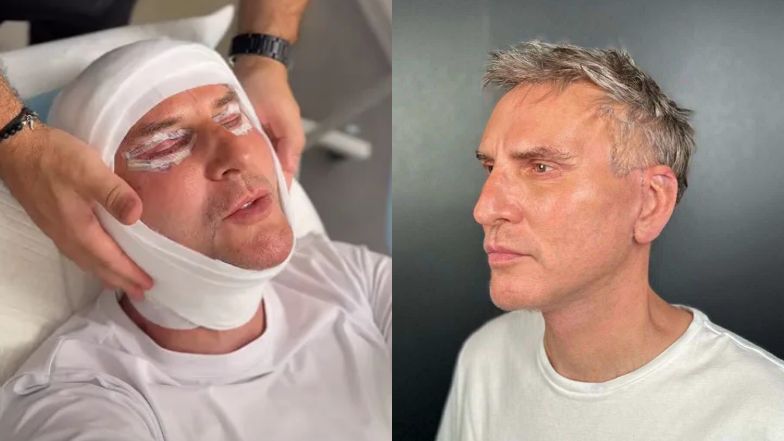 Krzysztof Gojdź pokazał się po zdjęciu szwów