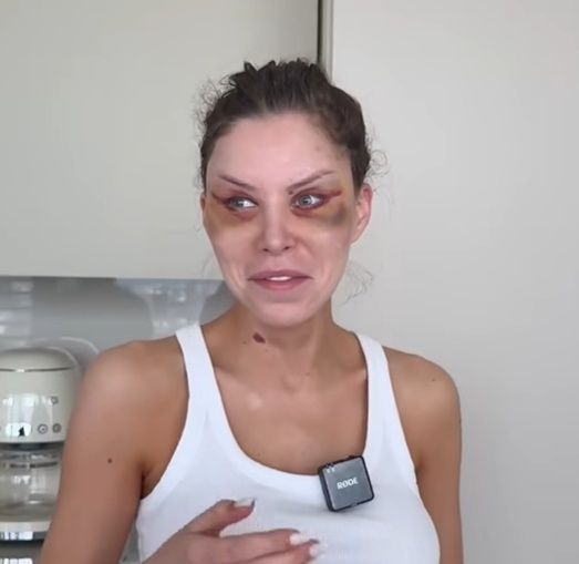 Julia von Stein po drugiej operacji