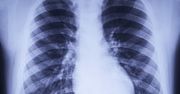 Koronawirus niewidoczny na zdjęciu RTG? Naukowcy: niektórzy zarażeni mają "czyste" płuca