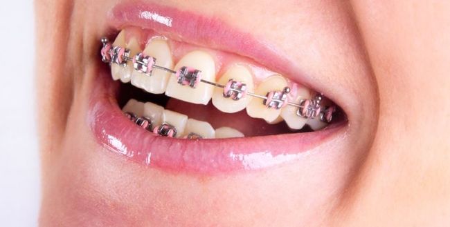 Niewłaściwie stosowane aparaty na zęby mogą być śmiertelnie niebezpieczne