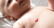 Naczyniak u noworodka – jak wyglądają i czy trzeba go leczyć?