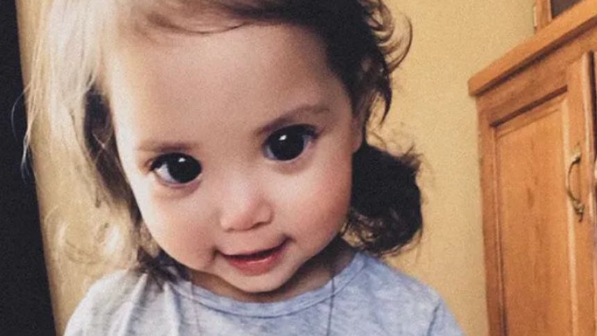 Ma ogromne oczy. Dziewczynka urodziła się z rzadką chorobą genetyczną