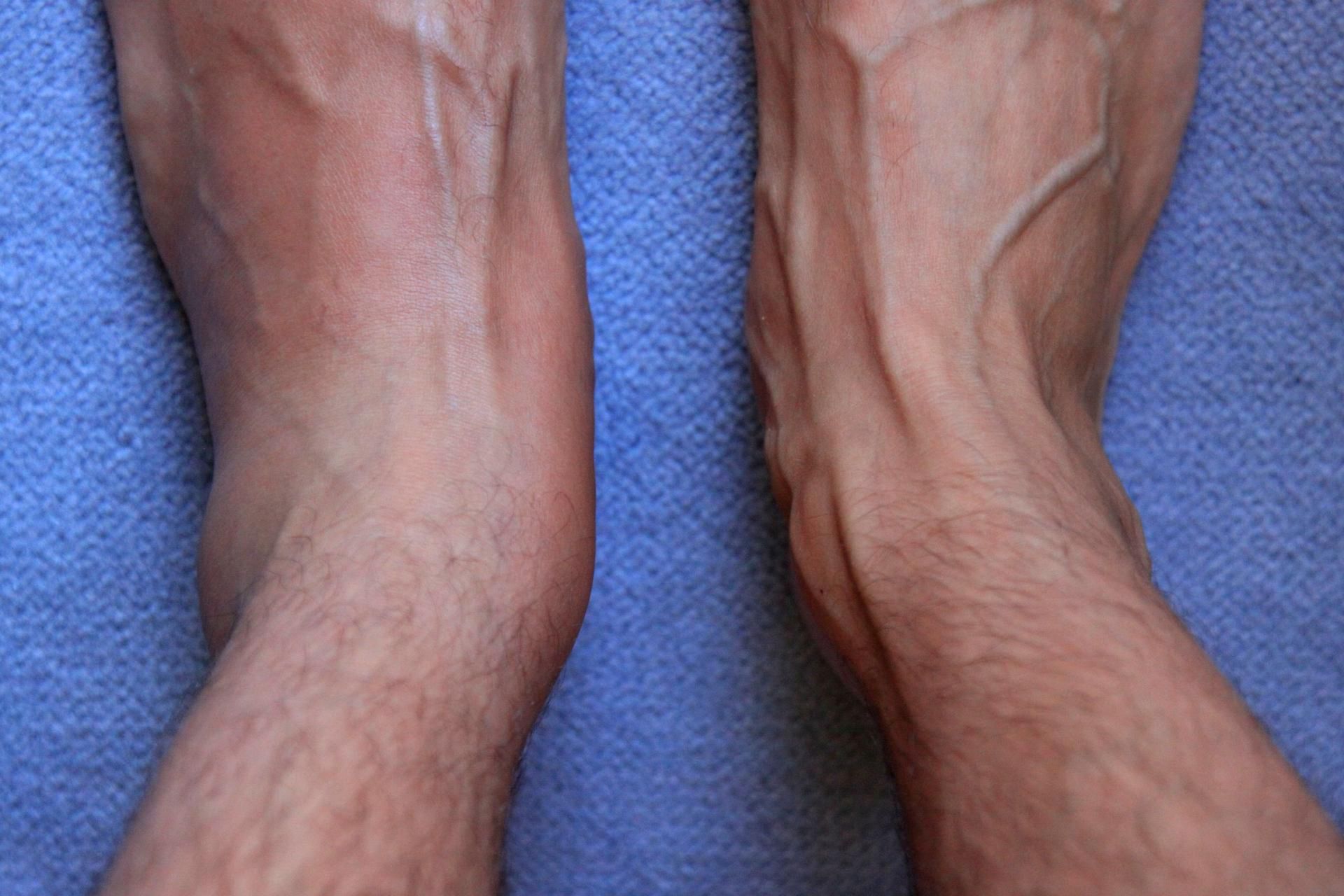 123rf.com Problemy z krążeniem mogą powodować puchnięcie kostek 