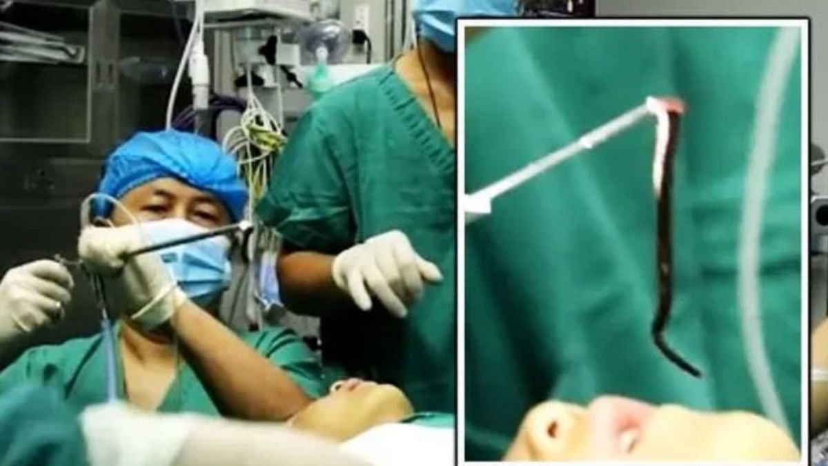 W gardle 5-letniego chłopca żyła 7- centymetrowa żywa pijawka.
