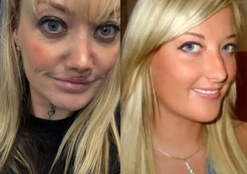 Zrobiła sobie zęby w Turcji. Przeraża, co stało się potem