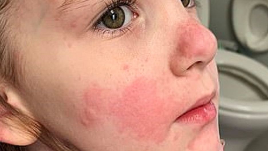 Nazywają ich wampirami. Wszystko przez rzadkie schorzenie