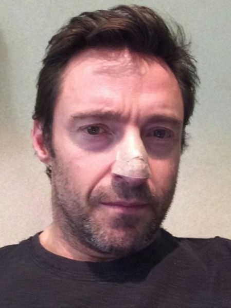 ''Wolverine'': U Hugh Jackmana zdiagnozowano raka