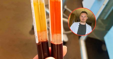 Test z krwi może pomóc wykryć raka jelita grubego. "Fantastyczna analiza"