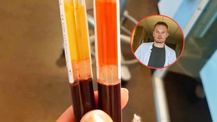 Test z krwi może pomóc wykryć raka jelita grubego. "Fantastyczna analiza"