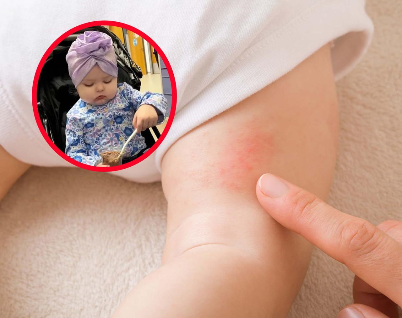 Objawem była wysypka na nogach. Tak rak atakował 2-latkę