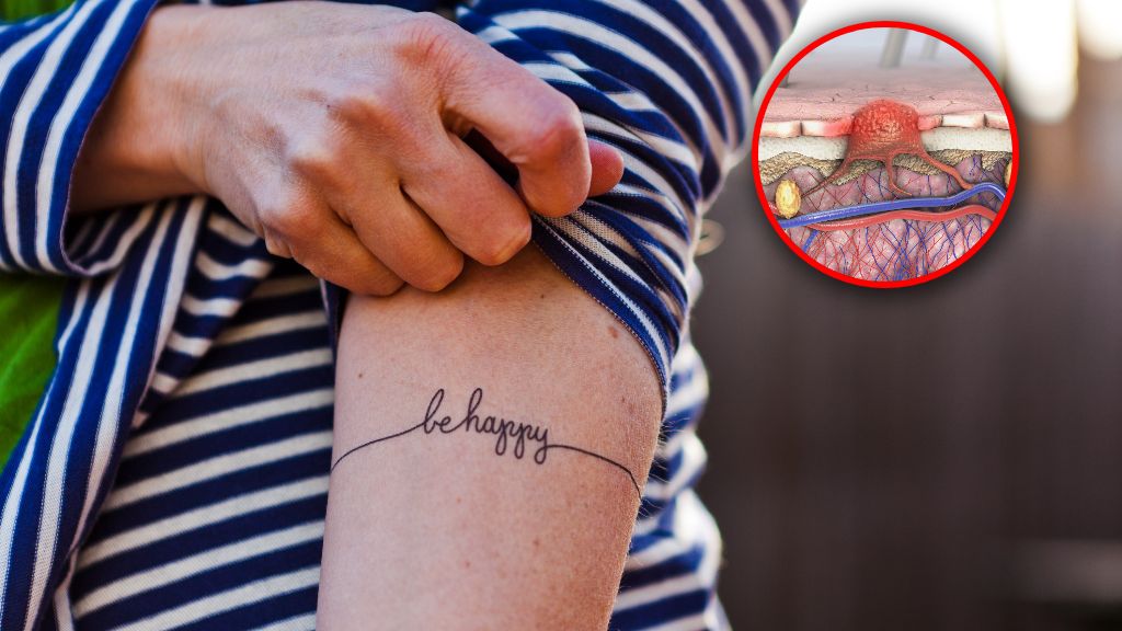 Rośnie liczba tatuaży i zachorowań na raka skóry