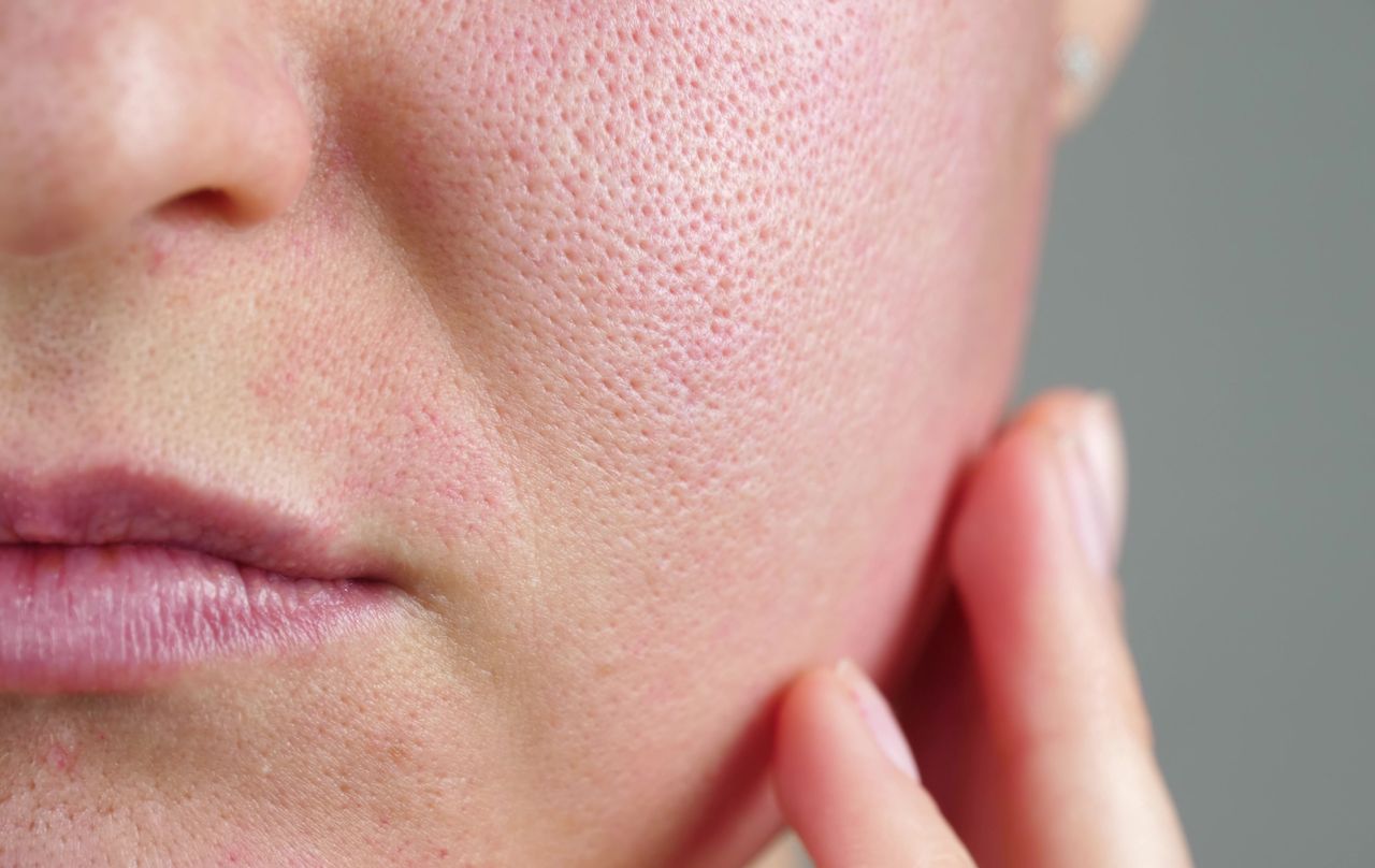 How to get rid of enlarged pores?