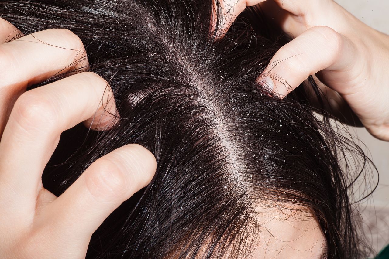 How to get rid of dandruff using natural methods?