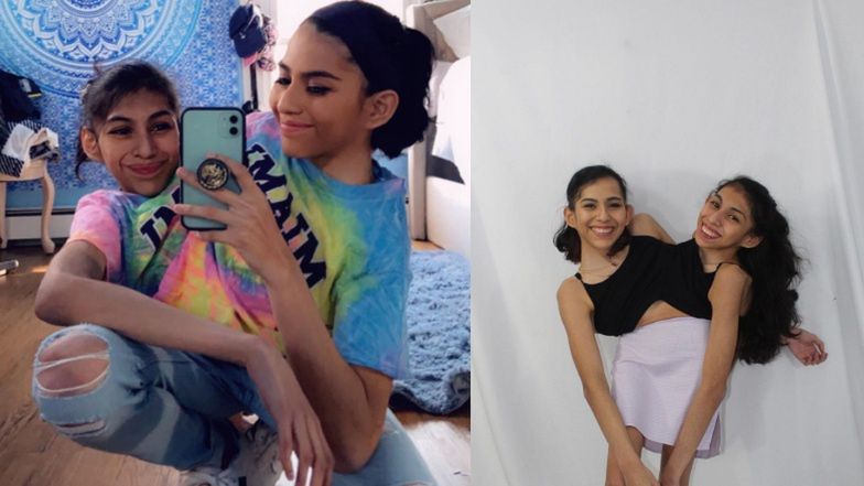 22-letnie bliźniaczki syjamskie podbijają media społecznościowe