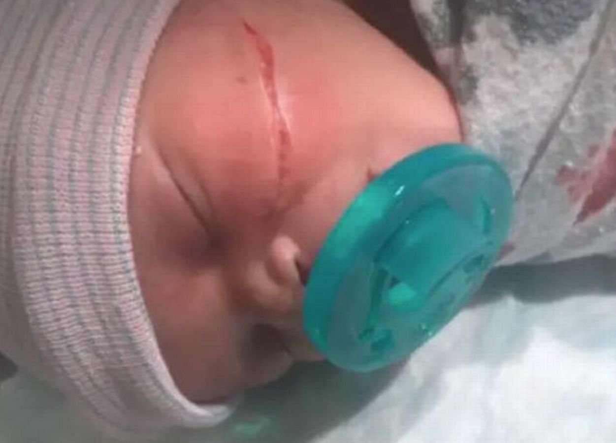 Dziecko urodziło się z wielką raną na twarzy. Lekarz popełnił błąd