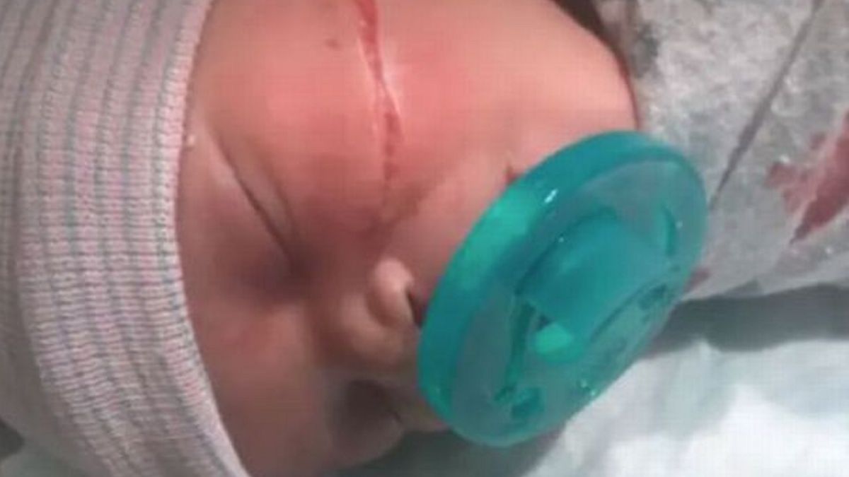 Dziecko ma 13 szwów po nieudanym cesarskim cięciu.