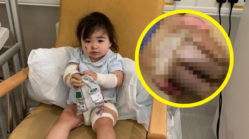 Kilkunastomiesięczna dziewczynka poparzyła się sosem z KFC