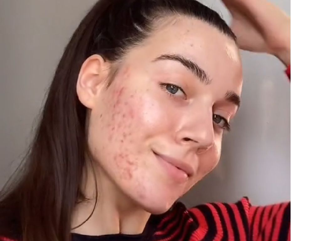 Tiktokerka nie wstydzi się pokazywać twarzy z trądzikiem. Promuje "acne positivity"