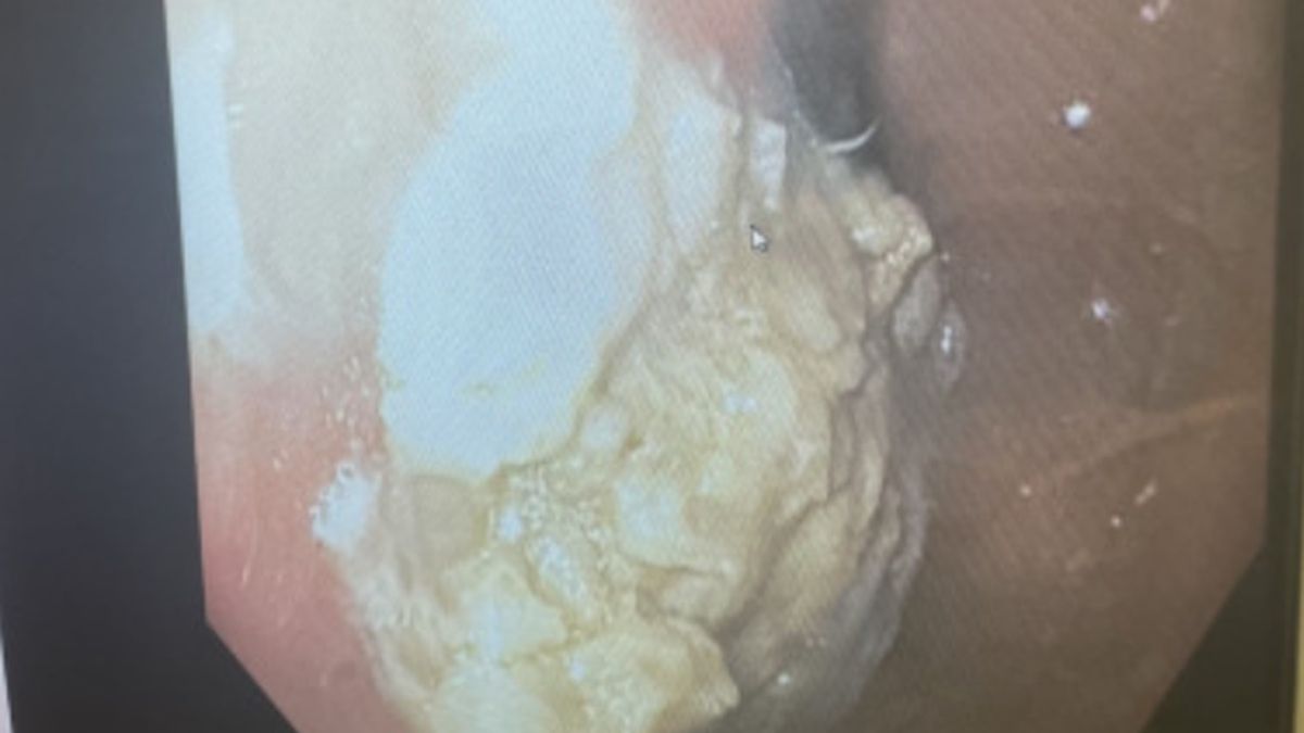 4-latek połknął kilkadziesiąt gum do żucia. W rezultacie musiał iść do szpitala