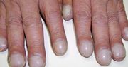 Palce pałeczkowate są objawem choroby