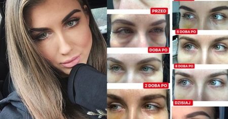 Deynn pokazała siniaki po "operacji worów"... Teraz jest lepiej? (FOTO)